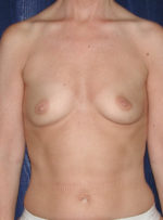 Breast Augmentation