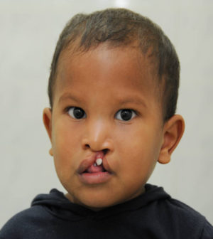 Cleft Palate / Cleft Lip