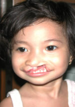 Cleft Palate / Cleft Lip