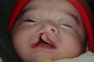 Cleft Palate / Cleft Lip