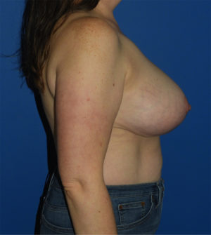 Breast Reduction