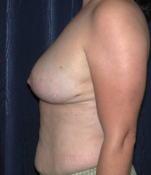 Breast Reduction