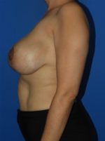 Breast Reduction