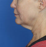 Natural Neck Lift