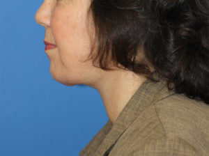 Natural Neck Lift Case 5980 After Photo Natural Neck Lift