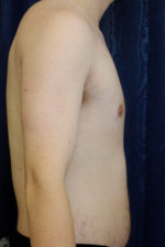 Gynecomastia