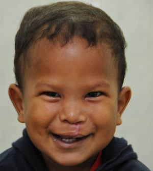 Cleft Palate / Cleft Lip