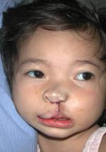 Cleft Palate / Cleft Lip