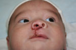 Cleft Palate / Cleft Lip