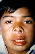 Cleft Palate / Cleft Lip