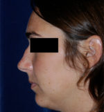 Rhinoplasty