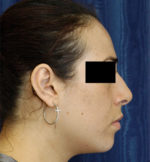 Rhinoplasty