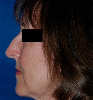 Rhinoplasty