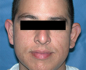 Ear Surgery (Otoplasty) Case 6021 Before Photo Ear Surgery (Otoplasty)