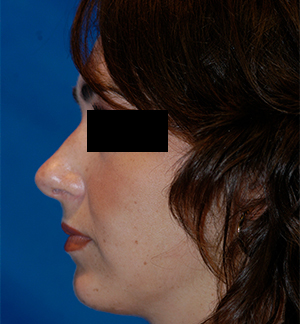 Rhinoplasty