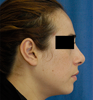 Rhinoplasty