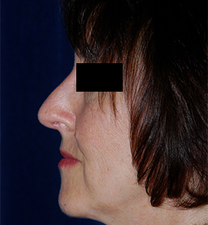 Rhinoplasty