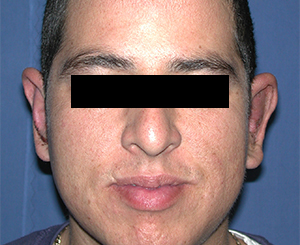 Ear Surgery (Otoplasty) Case 6021 After Photo Ear Surgery (Otoplasty)