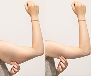 A split screen of a woman pinching the skin beneath her arm. Showing the before and after results of brachioplasty surgery, also called an arm lift.