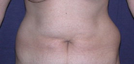 Before Abdominoplasty