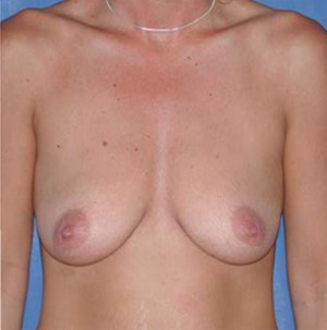 Breast Augmentation Results Monterey