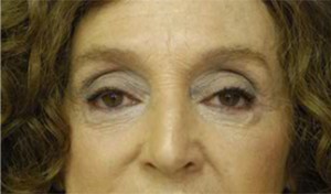 Eyelid Surgery Results