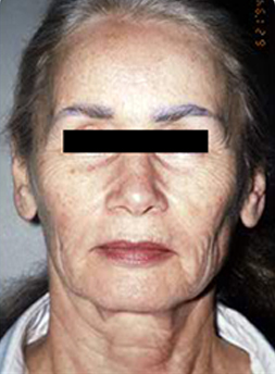 Facelift Before and After Results