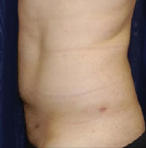 Liposuction Before & After Results