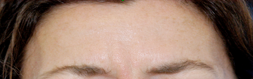 Botox Before and After Results