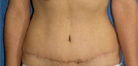 After Abdominoplasty