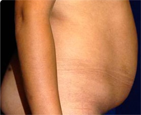 Abdominoplasty