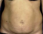 Abdominoplasty