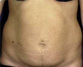 Abdominoplasty