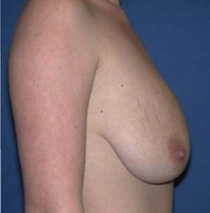 Breast Lift
