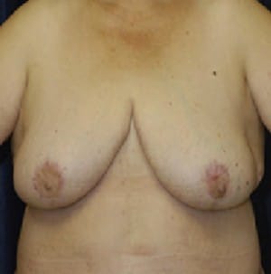 Breast Reduction