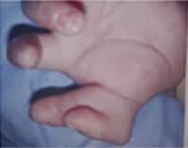 Congenital Deformities