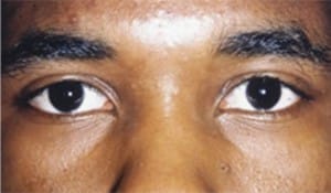 Eyelid (Blepharoplasty)
