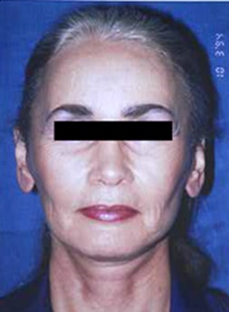 Facelift Before and After Results