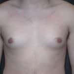 Gynecomastia