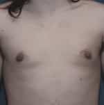 Gynecomastia