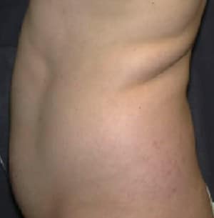 Liposuction Before & After Results