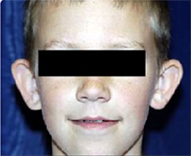 Ear Surgery (Otoplasty)
