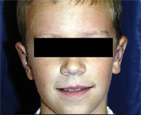 Ear Surgery (Otoplasty)