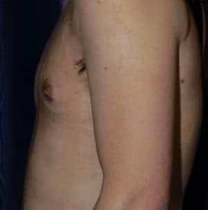 Gynecomastia