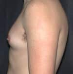 Gynecomastia