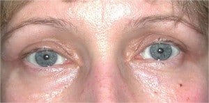 Eyelid (Blepharoplasty)