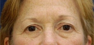 Eyelid (Blepharoplasty)