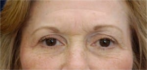 Eyelid (Blepharoplasty)