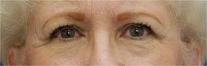 Eyelid (Blepharoplasty)