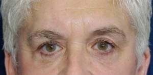 Eyelid (Blepharoplasty)